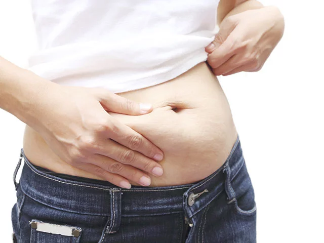 6.- Abdominoplastia: ¿Una persona con sobrepeso se puede realizársela?