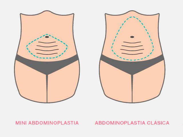 Diferencias entre Abdominoplastia Mini y Completa