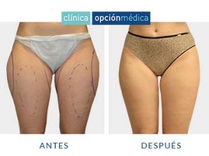 antes y después liposucción clínica opción médica