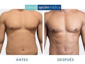 liposucción abdomen hombre clínica opción médica
