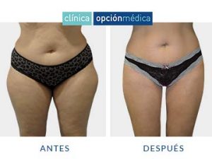 resultados de liposucción clínica opción médica barcelona
