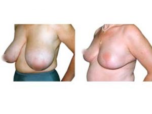 antes y después reducción de mamas clínica opción médica