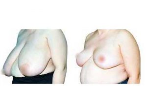 resultados reducción de mamas clínica opción médica