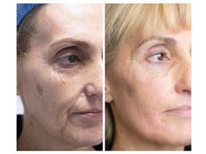 antes y después tratamiento de manchas faciales