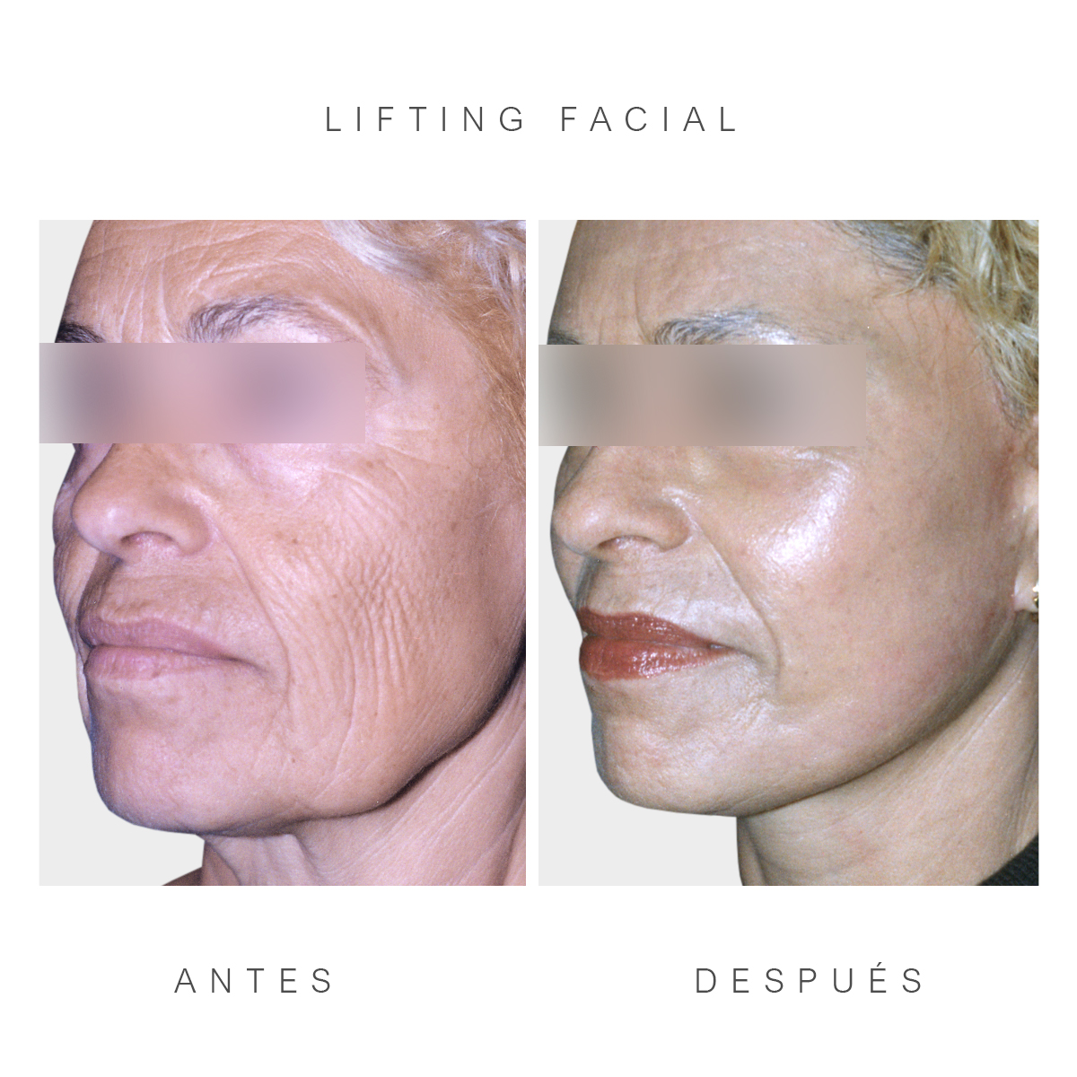 Lifting Facial: recupera la juventud y vitalidad de tu rostro en Clínica Opción Médica